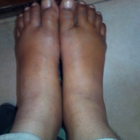 Both Foot Edema in Rheumatoid Arthritis