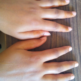 Both Hand Edema in Rheumatoid Arthritis