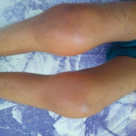 Knee Swelling in Juvenile Rheumatoid Arhtritis (JRA)